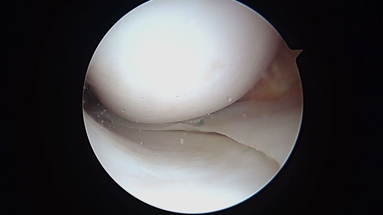 pohled na kolenní kloub přes artroskop