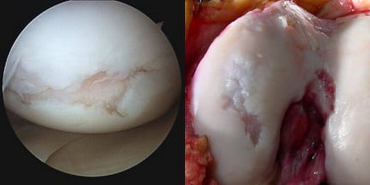 při operaci je viditelné poškození kolenního kloubu