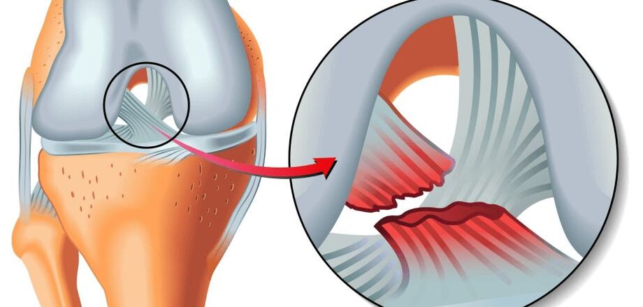 zraněného kolenního kloubu