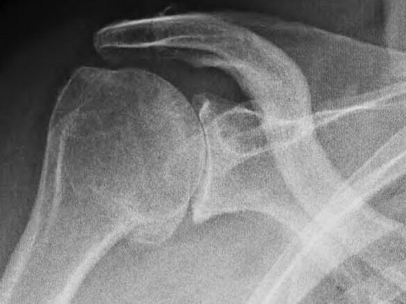 Rentgenový snímek ramenního kloubu postiženého artrózou