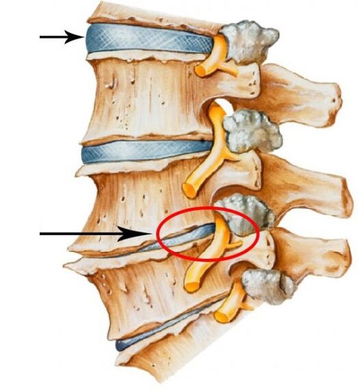 Cervikální osteochondrosis