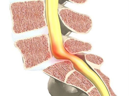 Segment motoru krve pro osteochondrosu