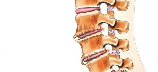 Spondylóza - Zničení meziobratlových kloubů