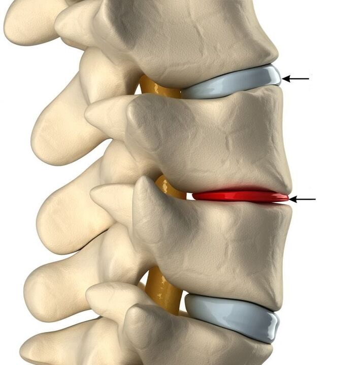 Rozdíl mezi zdravým diskem a diskem s osteochondózou