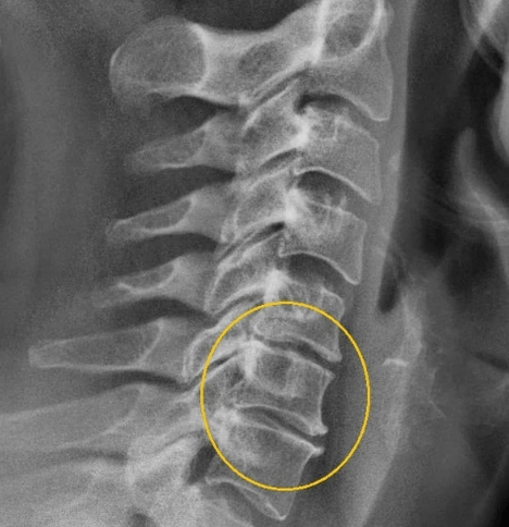 cervikální osteochondróza
