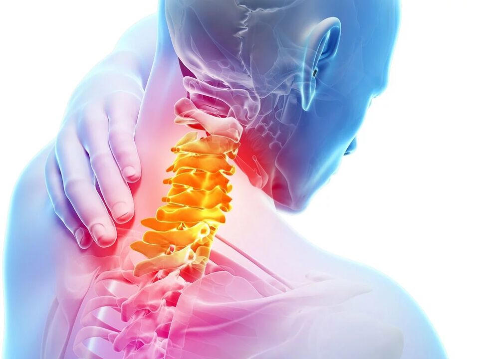 Cervikální osteochondróza