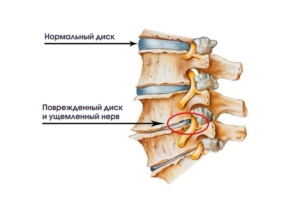 Příznaky cervikální osteochondrózy