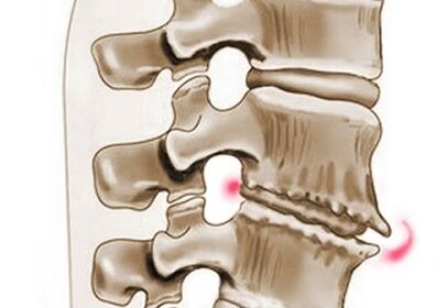 poškození obratlů při hrudní osteochondróze