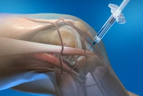 intraartikulární injekce pro artrózu kolenního kloubu